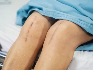 عفونت بعد از تعویض مفصل زانو