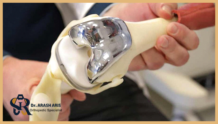 عوامل تاثیرگذار بر هزینه جراحی تعویض مفصل زانو