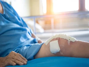 نکات مراقبتی بعد از آرتروسکوپی زانو