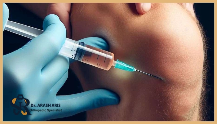 عوامل تاثیرگذار بر هزینه پی آر پی زانو