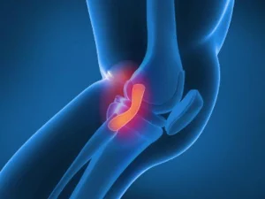 علائم پارگی رباط صلیبی
